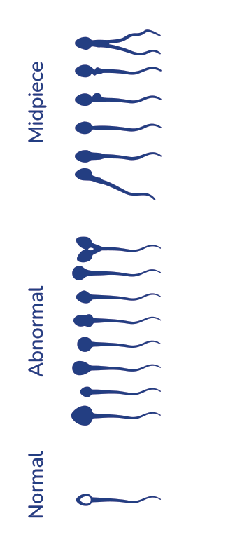 Anomalies du spermogramme : diagnostic et prise en charge thérapeutique